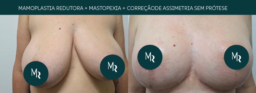 Mamoplastia redutora, mastopexia e correção de assimetria sem prótese