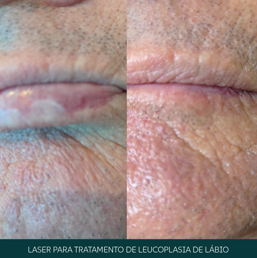 Laser para tratamento de leucoplasia de lábio